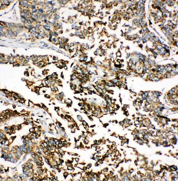 HSPA5 / GRP78 / BiP Antibody - HSPA5 / GRP78 / BIP antibody. IHC(P): Human Lung Cancer Tissue.