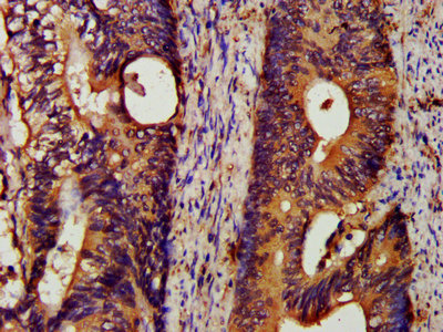 HSPA5 / GRP78 / BiP Antibody - IHC image of HSPA5 Antibody diluted at 1:200 and staining in paraffin-embedded human colon cancer performed on a Leica BondTM system. After dewaxing and hydration, antigen retrieval was mediated by high pressure in a citrate buffer (pH 6.0). Section was blocked with 10% normal goat serum 30min at RT. Then primary antibody (1% BSA) was incubated at 4°C overnight. The primary is detected by a biotinylated secondary antibody and visualized using an HRP conjugated SP system.