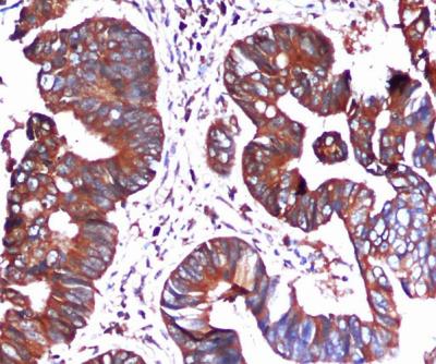 HSPA5 / GRP78 / BiP Antibody - Immunohistochemical analysis of paraffin-embedded Colorectal cancer using BiP/GRP78 (C-terminus) mouse monoclonal antibody (1:100 dilution).Antigen retrieval was performed by pressure cooking in citrate buffer (pH 6.0).