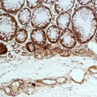 HSPA5 / GRP78 / BiP Antibody - Immunohistochemical analysis of GRP78 staining in human colon cancer;human breast cancer formalin fixed paraffin embedded tissue section. The section was pre-treated using heat mediated antigen retrieval with sodium citrate buffer (pH 6.0). The section was then incubated with the antibody at room temperature and detected using an HRP conjugated compact polymer system. DAB was used as the chromogen. The section was then counterstained with hematoxylin and mounted with DPX.