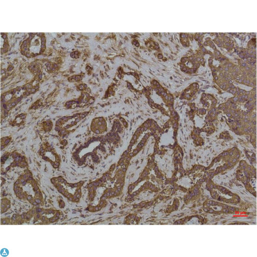 HSPA5 / GRP78 / BiP Antibody - Immunohistochemistry (IHC) analysis of paraffin-embedded Human Colon Carcicnoma using GRP78/Bip Mouse Monoclonal Antibody diluted at 1:200.