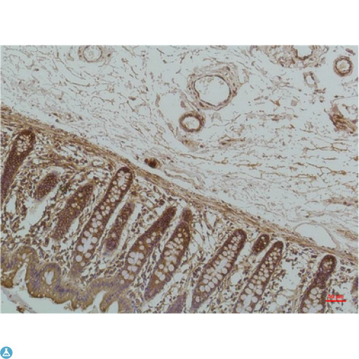 HSPA5 / GRP78 / BiP Antibody - Immunohistochemistry (IHC) analysis of paraffin-embedded Human Breast Carcicnoma using GRP78/Bip Mouse Monoclonal Antibody diluted at 1:200.