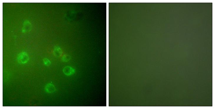 HSPA5 / GRP78 / BiP Antibody - Peptide - + Immunohistochemical analysis of paraffin-embedded human breast carcinoma tissue using GRP78 antibody.