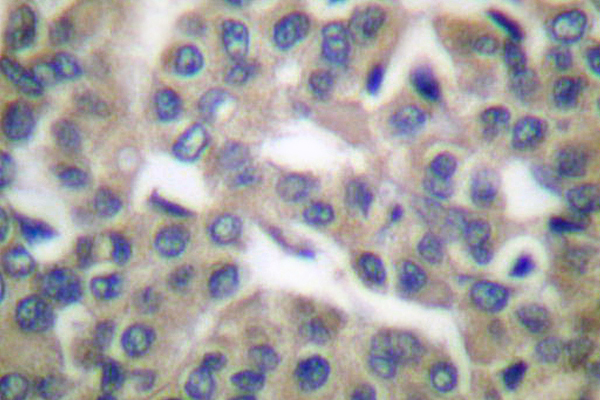 HSPA5 / GRP78 / BiP Antibody - IHC of GRP78 (P641) pAb in paraffin-embedded human breast carcinoma tissue.
