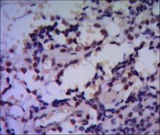 HSPA6 / HSP70B' Antibody - IHC of paraffin-embedded human breast cancer using HSP70 mouse monoclonal antibody with DAB staining.