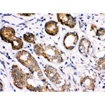 HSPA8 / HSC70 Antibody - Hsc70 antibody IHC-paraffin. IHC(P): Human Mammary Cancer Tissue.