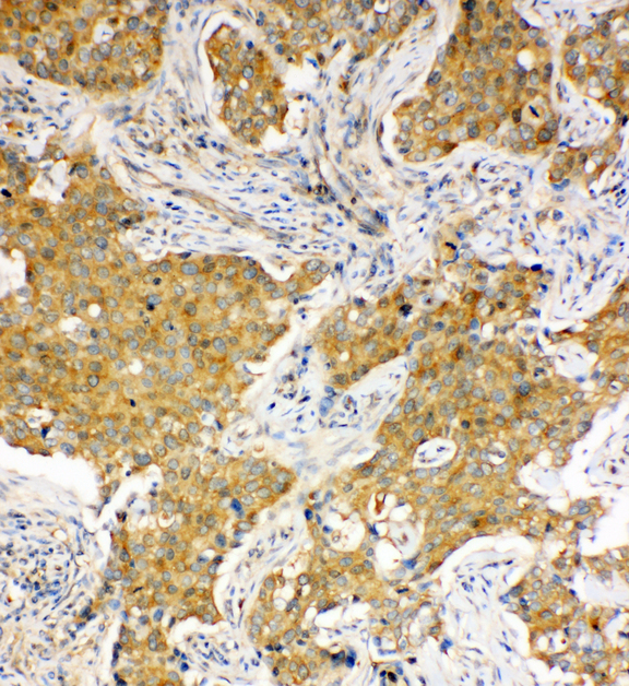 HSPA8 / HSC70 Antibody - HSPA8 / HSC70 antibody. IHC(P):Human Lung Cancer Tissue.
