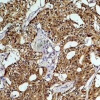 HSPA8 / HSC70 Antibody - Immunohistochemical analysis of HSC70 staining in human breast cancer formalin fixed paraffin embedded tissue section. The section was pre-treated using heat mediated antigen retrieval with sodium citrate buffer (pH 6.0). The section was then incubated with the antibody at room temperature and detected using an HRP conjugated compact polymer system. DAB was used as the chromogen. The section was then counterstained with hematoxylin and mounted with DPX.