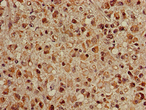 HSPA8 / HSC70 Antibody - Immunohistochemistry of paraffin-embedded human glioma cancer using HSPA8 Antibody at dilution of 1:100