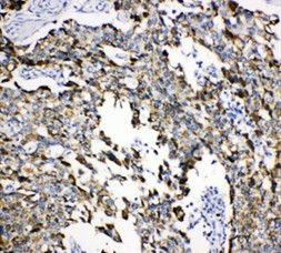 HSPA9 / Mortalin / GRP75 Antibody - HSPA9 / Mortalin / GRP75 antibody. IHC(P): Human Lung Cancer Tissue.