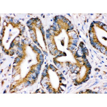 HSPA9 / Mortalin / GRP75 Antibody - Grp75 antibody IHC-paraffin. IHC(P): Human Intestinal Cancer Tissue.
