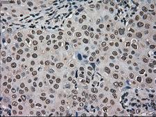 HSPA9 / Mortalin / GRP75 Antibody - Immunohistochemical staining of paraffin-embedded Adenocarcinoma of breast tissue using antiHSPA9 mouse monoclonal antibody. (Dilution 1:50).