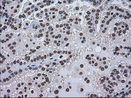 HSPA9 / Mortalin / GRP75 Antibody - Immunohistochemical staining of paraffin-embedded Carcinoma of kidney tissue using antiHSPA9 mouse monoclonal antibody. (Dilution 1:50).
