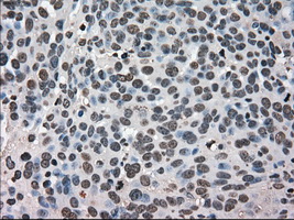 HSPA9 / Mortalin / GRP75 Antibody - Immunohistochemical staining of paraffin-embedded Adenocarcinoma of ovary tissue using antiHSPA9 mouse monoclonal antibody. (Dilution 1:50).