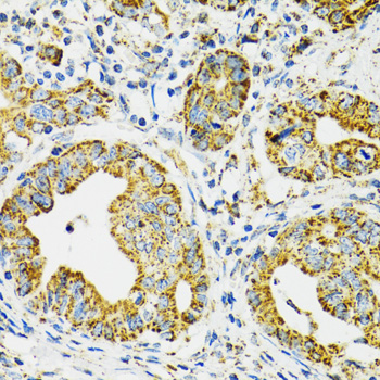 HSPA9 / Mortalin / GRP75 Antibody - Immunohistochemistry of paraffin-embedded human gastric cancer using HSPA9 antibodyat dilution of 1:100 (40x lens).
