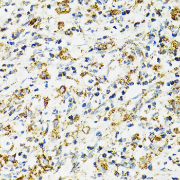 HSPA9 / Mortalin / GRP75 Antibody - Immunohistochemistry of paraffin-embedded human uterine cancer using HSPA9 antibodyat dilution of 1:100 (40x lens).