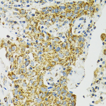 HSPA9 / Mortalin / GRP75 Antibody - Immunohistochemistry of paraffin-embedded human lung cancer using HSPA9 antibodyat dilution of 1:100 (40x lens).