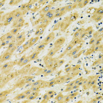 HSPA9 / Mortalin / GRP75 Antibody - Immunohistochemistry of paraffin-embedded human liver cancer using HSPA9 antibodyat dilution of 1:100 (40x lens).