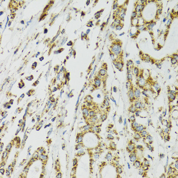 HSPA9 / Mortalin / GRP75 Antibody - Immunohistochemistry of paraffin-embedded human colon carcinoma using HSPA9 antibodyat dilution of 1:100 (40x lens).