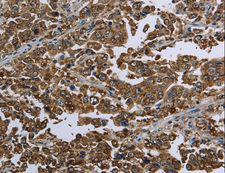 HSPA9 / Mortalin / GRP75 Antibody - Immunohistochemistry of paraffin-embedded Human liver cancer using HSPA9 Polyclonal Antibody at dilution of 1:50.