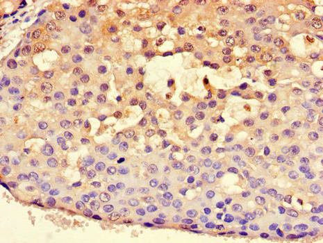 HSPA9 / Mortalin / GRP75 Antibody - Immunohistochemistry of paraffin-embedded human breast cancer using HSPA9 Antibody at dilution of 1:100