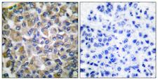 HSPA9 / Mortalin / GRP75 Antibody - Peptide - + Immunohistochemical analysis of paraffin-embedded human breast carcinoma tissue using GRP75 antibody.