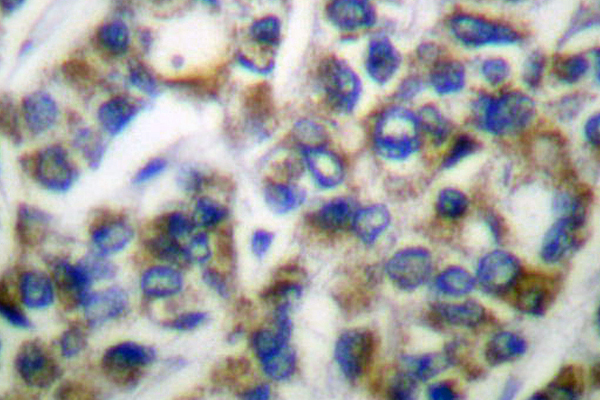 HSPA9 / Mortalin / GRP75 Antibody - IHC of GRP75/HSPA9 (S664) pAb in paraffin-embedded human breast carcinoma tissue.