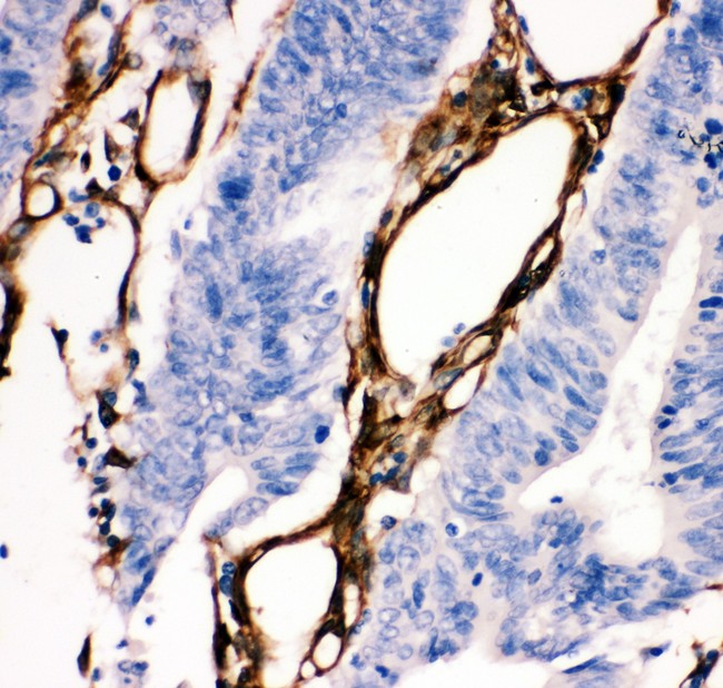 HSPB1 / HSP27 Antibody - HSP27 antibody IHC-paraffin: Human Intestinal Cancer Tissue.