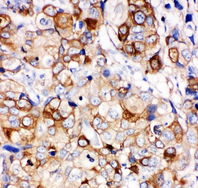 HSPB1 / HSP27 Antibody - HSP27 antibody IHC-paraffin: Human Mammary Cancer Tissue.