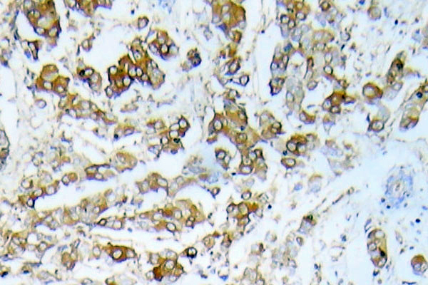 HSPB1 / HSP27 Antibody - Immunohistochemistry analysis of HSP27 antibody in paraffin-embedded human breast carcinoma tissue.
