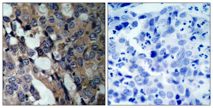 HSPB1 / HSP27 Antibody - Immunohistochemistry analysis of paraffin-embedded human breast carcinoma tissue, using HSP27 Antibody. The picture on the right is blocked with the synthesized peptide.