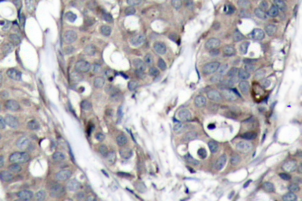 HSPB1 / HSP27 Antibody - IHC of HSP27 (A72) pAb in paraffin-embedded human breast carcinoma tissue.