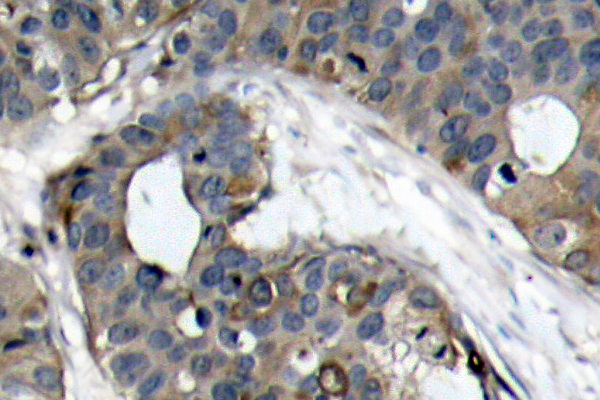 HSPB1 / HSP27 Antibody - IHC of HSP27 (R75) pAb in paraffin-embedded human breast carcinoma tissue.