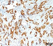 HSPB1 / HSP27 Antibody - HSP27 antibody G3.1 immunohistochemistry breast carcinoma 10X.  This image was taken for the unmodified form of this product. Other forms have not been tested.