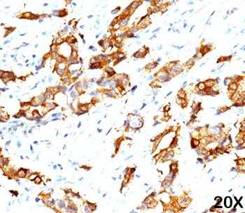 HSPB1 / HSP27 Antibody - HSP27 antibody G3.1 immunohistochemistry breast carcinoma 20X.  This image was taken for the unmodified form of this product. Other forms have not been tested.