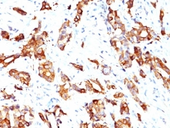 HSPB1 / HSP27 Antibody - Formalin-fixed, paraffin-embedded human breast carcinoma stained with HSP27 antibody (HSPB1/774).  This image was taken for the unmodified form of this product. Other forms have not been tested.