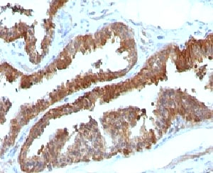 HSPB1 / HSP27 Antibody - Formalin-fixed, paraffin-embedded human prostate carcinoma stained with HSP27 antibody (HSPB1/774).  This image was taken for the unmodified form of this product. Other forms have not been tested.