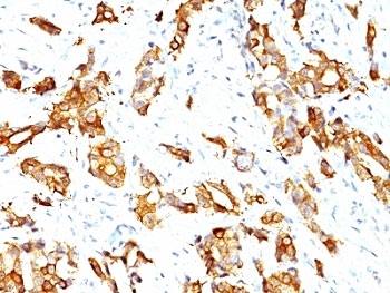 HSPB1 / HSP27 Antibody - Formalin-fixed, paraffin-embedded human breast carcinoma stained with HSP27 antibody (SPM252).  This image was taken for the unmodified form of this product. Other forms have not been tested.