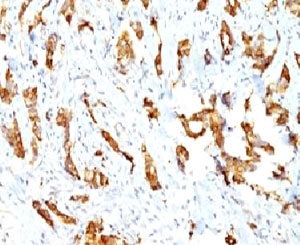 HSPB1 / HSP27 Antibody - Formalin-fixed, paraffin-embedded human breast carcinoma stained with HSP27 antibody (SPM252).  This image was taken for the unmodified form of this product. Other forms have not been tested.