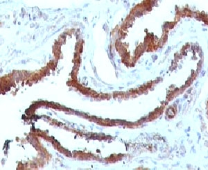 HSPB1 / HSP27 Antibody - IHC testing of FFPE human prostate carcinoma and HSP27 antibody (clone SRPR27).  This image was taken for the unmodified form of this product. Other forms have not been tested.