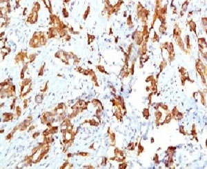 HSPB1 / HSP27 Antibody - IHC testing of FFPE human breast carcinoma and HSP27 antibody (clone SRPR27).  This image was taken for the unmodified form of this product. Other forms have not been tested.