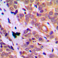 HSPB1 / HSP27 Antibody - Immunohistochemical analysis of HSP27 staining in human breast cancer formalin fixed paraffin embedded tissue section. The section was pre-treated using heat mediated antigen retrieval with sodium citrate buffer (pH 6.0). The section was then incubated with the antibody at room temperature and detected using an HRP conjugated compact polymer system. DAB was used as the chromogen. The section was then counterstained with hematoxylin and mounted with DPX.