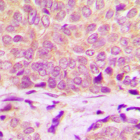 HSPB1 / HSP27 Antibody - Immunohistochemical analysis of HSP27 staining in human breast cancer formalin fixed paraffin embedded tissue section. The section was pre-treated using heat mediated antigen retrieval with sodium citrate buffer (pH 6.0). The section was then incubated with the antibody at room temperature and detected using an HRP conjugated compact polymer system. DAB was used as the chromogen. The section was then counterstained with hematoxylin and mounted with DPX.