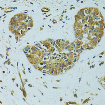 HSPB1 / HSP27 Antibody - Immunohistochemistry of paraffin-embedded human breast cancer using HSPB1 antibodyat dilution of 1:100 (40x lens).