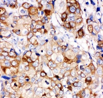 HSPB1 / HSP27 Antibody - IHC-P: HSP27 antibody testing of human breast cancer tissue