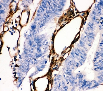 HSPB1 / HSP27 Antibody - IHC-P: HSP27 antibody testing of human intestine cancer tissue