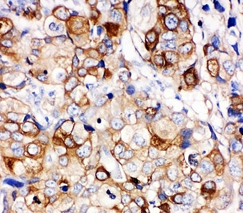 HSPB1 / HSP27 Antibody - IHC-P: HSP27 antibody testing of human breast cancer tissue