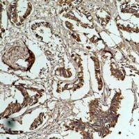 HSPB1 / HSP27 Antibody - Immunohistochemical analysis of HSP27 staining in human breast cancer formalin fixed paraffin embedded tissue section. The section was pre-treated using heat mediated antigen retrieval with sodium citrate buffer (pH 6.0). The section was then incubated with the antibody at room temperature and detected using an HRP conjugated compact polymer system. DAB was used as the chromogen. The section was then counterstained with hematoxylin and mounted with DPX.