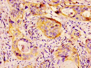 HSPB1 / HSP27 Antibody - Immunohistochemistry image at a dilution of 1:300 and staining in paraffin-embedded human cervical cancer performed on a Leica BondTM system. After dewaxing and hydration, antigen retrieval was mediated by high pressure in a citrate buffer (pH 6.0) . Section was blocked with 10% normal goat serum 30min at RT. Then primary antibody (1% BSA) was incubated at 4 °C overnight. The primary is detected by a biotinylated secondary antibody and visualized using an HRP conjugated SP system.