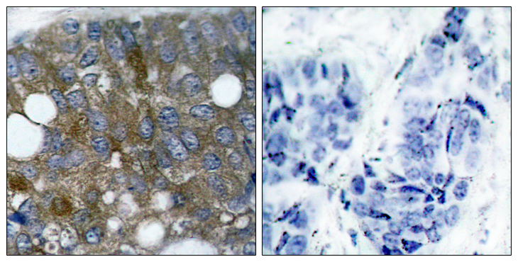 HSPB1 / HSP27 Antibody - Immunohistochemistry analysis of paraffin-embedded human breast carcinoma, using HSP27 (Phospho-Ser15) Antibody. The picture on the right is blocked with the phospho peptide.